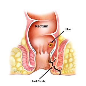 Anal Fistula