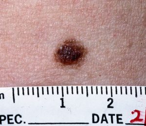 Nevus Treatment