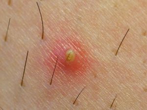 Ingrown Hair