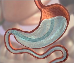 Gastric Balloon