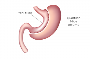 Tube Stomach Surgery